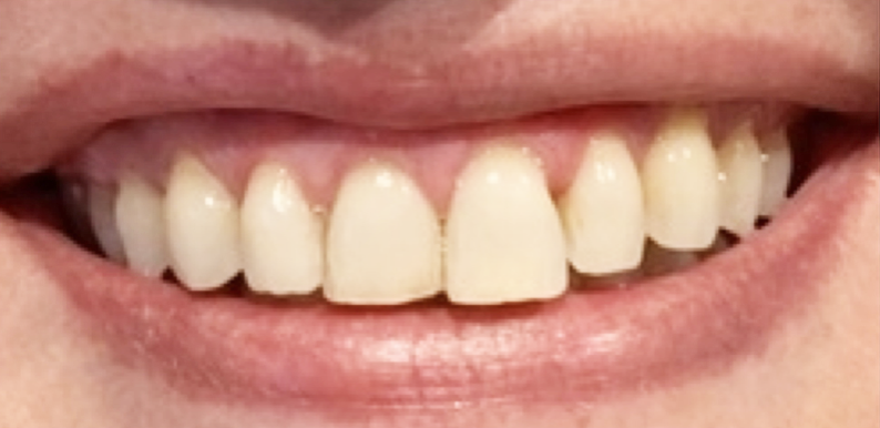 Smile-13_before.png
