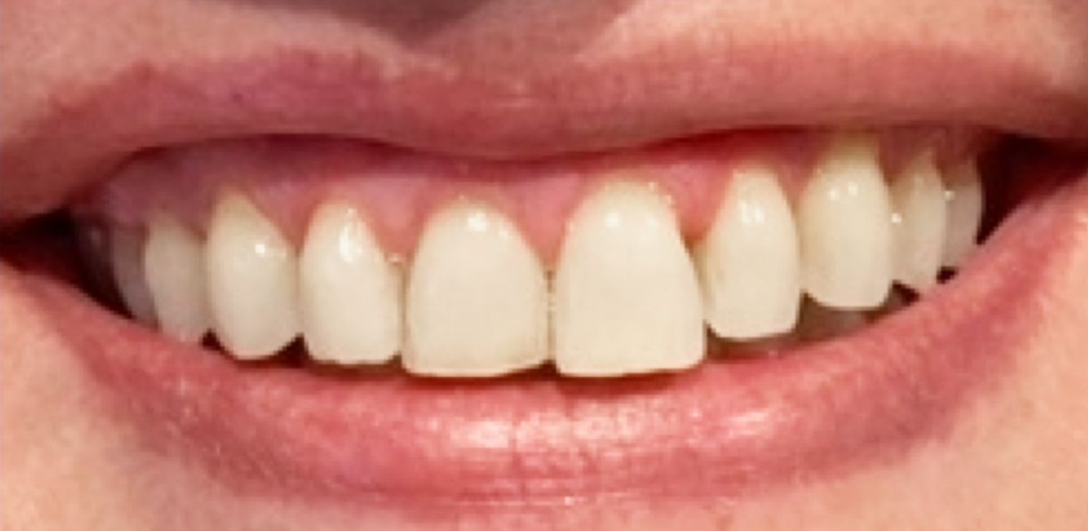 Smile-20_before.jpg
