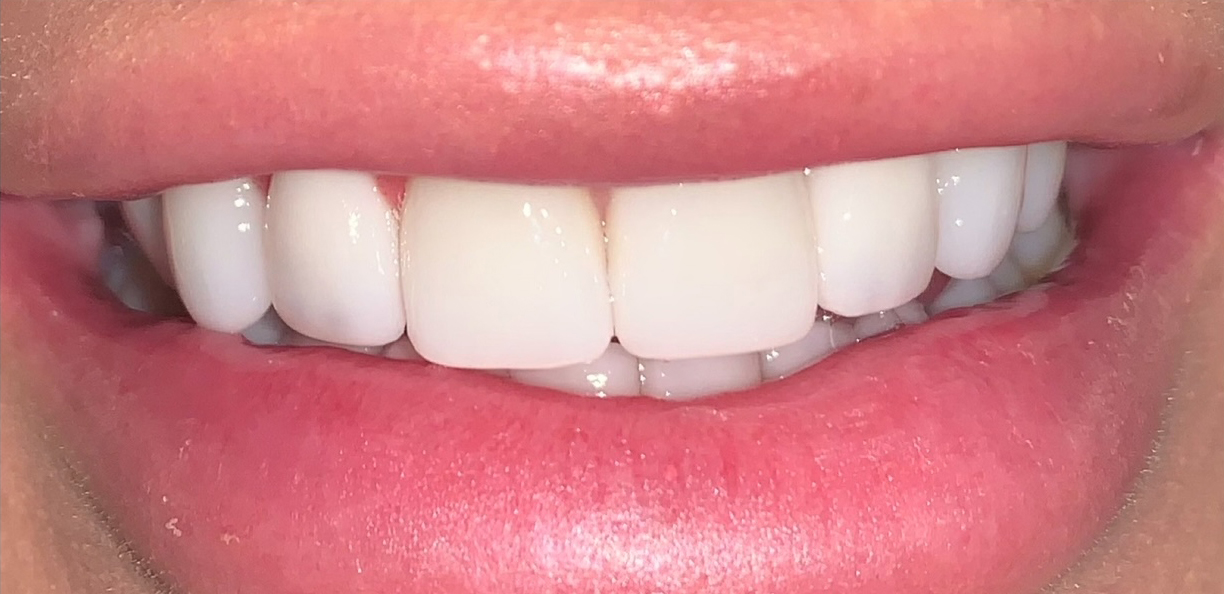 Smile-23_after.jpg