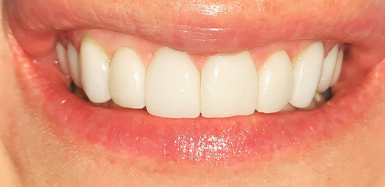 Smile-26_after.jpg