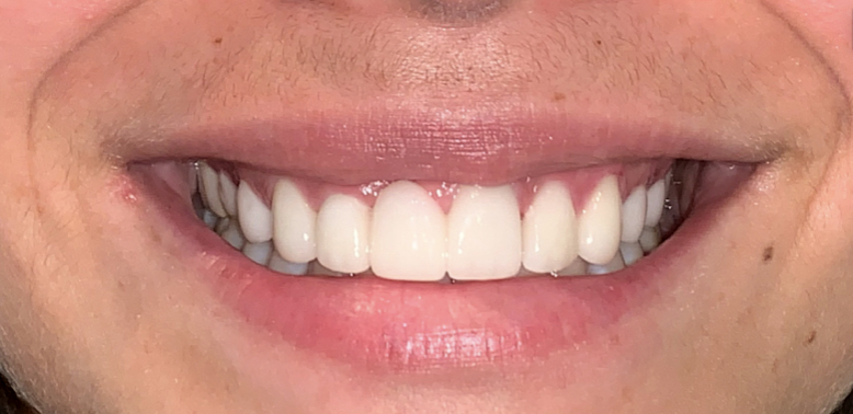 Smile-8_after.png